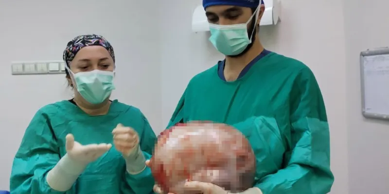 2 Ayda Hamile Gibi Şişti! Kadının Karnından Çıkan Karpuz Şok Etti